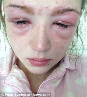 Чуть не ослепла краска для ресниц, аллергическая реакция на краску для ресниц