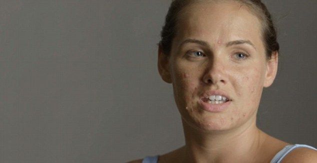 проблема акне, прыщи до и после, визажист нанес прыщи на лицо модели, Меган Морвуд, Megan Morewood