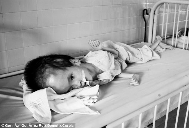 Спустя 50 лет дети продолжают страдать от ужасных последствий использования США химического оружия во Вьетнаме Последствия Agent Orange, война во Вьетнаме, Agent Orange, дети