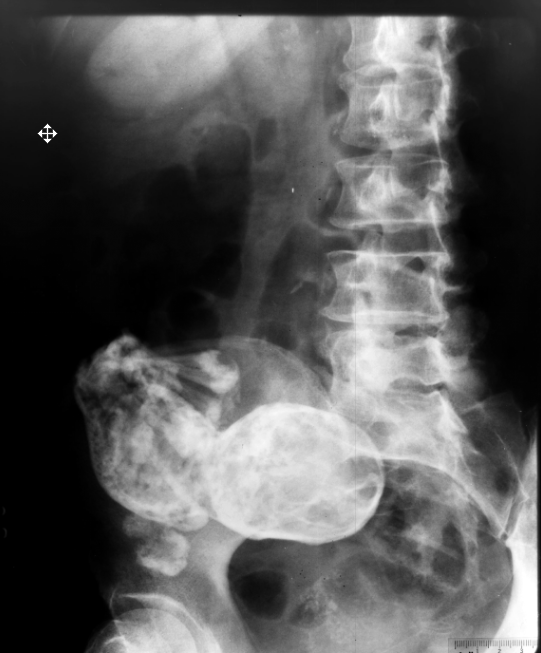 У 84-летней женщины внутри утробы нашли 44-летний эмбрион у 84-летней женщины, внутри утробы, в животе, нашли, 44-летний эмбрион, окаменелый, lithopedion