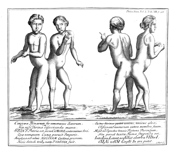 истории о сиамских близнецах, сиамские близнецы, сросшиеся