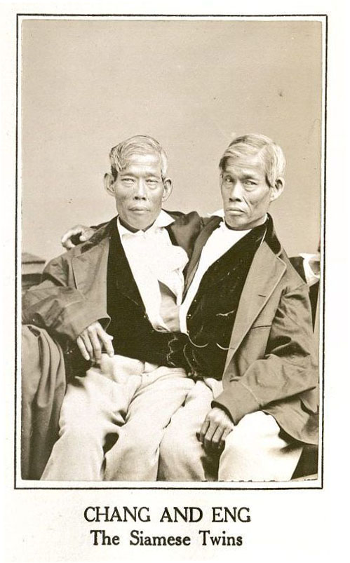 истории о сиамских близнецах, сиамские близнецы, сросшиеся