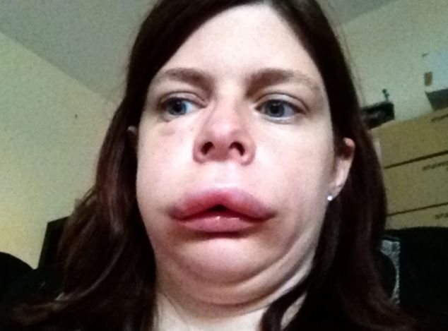 отек квинке, наследственный отек квинке, отек органов, отек лица женщины, Иззи Ричардс