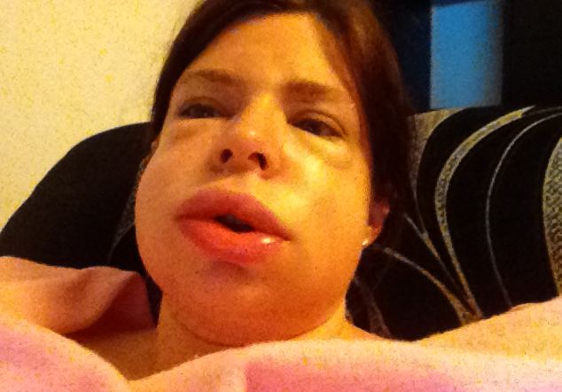 отек квинке, наследственный отек квинке, отек органов, отек лица женщины, Иззи Ричардс