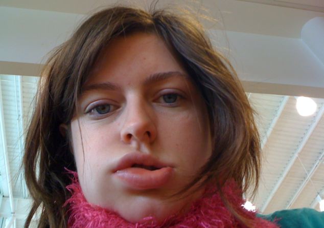 отек квинке, наследственный отек квинке, отек органов, отек лица женщины, Иззи Ричардс