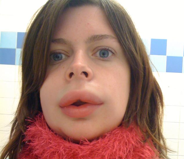 отек квинке, наследственный отек квинке, отек органов, отек лица женщины, Иззи Ричардс