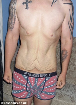 отказано в удалении лишней кожи, похудел на 108 кг, после похудения набрал мышцы,  Джейкоб Хорнер, Jacob Horner