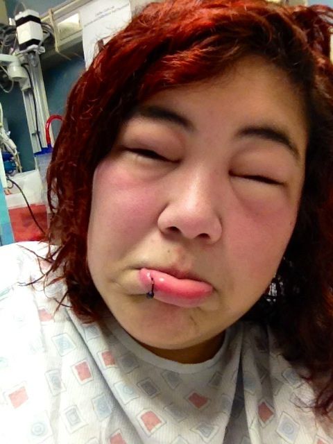 последствия укуса пчелы, пчелиного укуса, аллергия на пчелиный укус, укус пчелы, отек лица