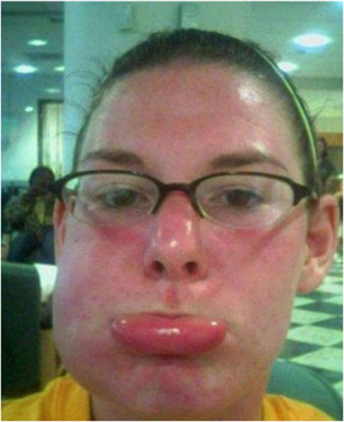 последствия укуса пчелы, пчелиного укуса, аллергия на пчелиный укус, укус пчелы, отек лица