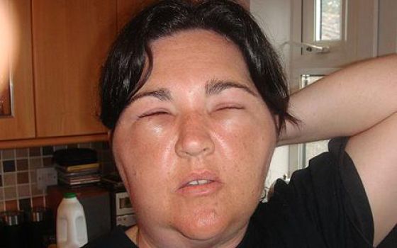 последствия укуса пчелы, пчелиного укуса, аллергия на пчелиный укус, укус пчелы, отек лица