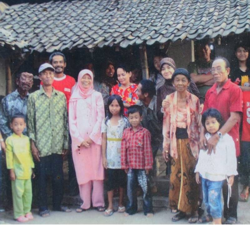 Человек-пузырь и его ужасное заболевание Человек-пузырь Сламет, ужасное заболевание, нейрофиброматоз