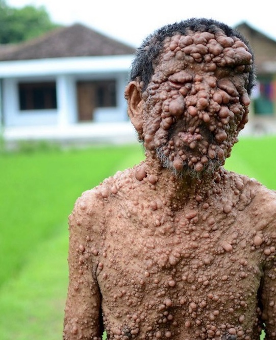 Человек-пузырь и его ужасное заболевание Человек-пузырь Сламет, ужасное заболевание, нейрофиброматоз