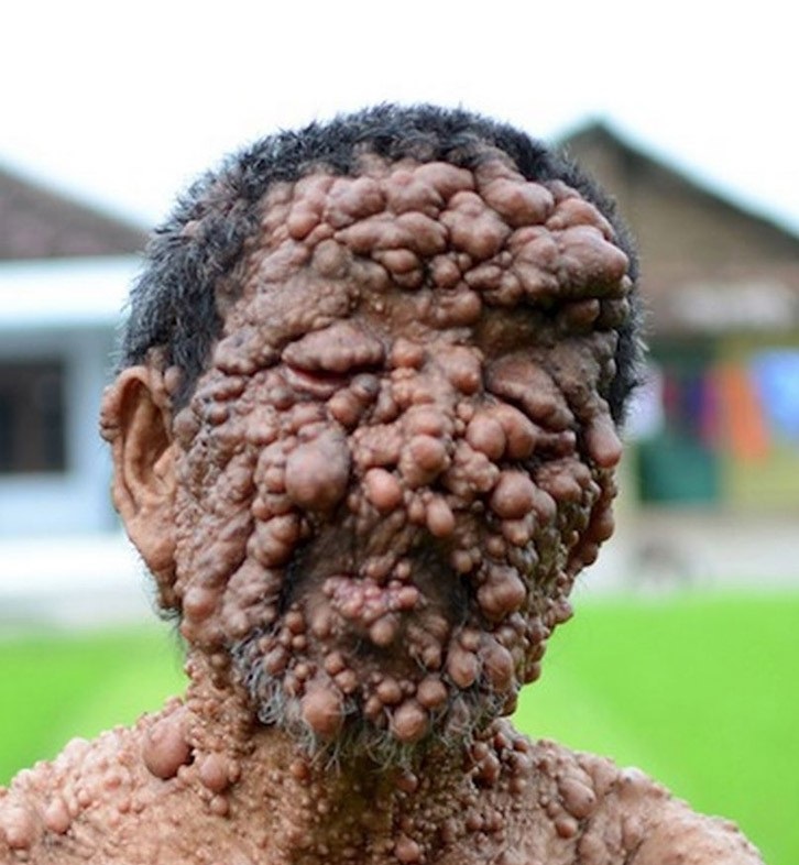 Человек-пузырь и его ужасное заболевание Человек-пузырь Сламет, ужасное заболевание, нейрофиброматоз