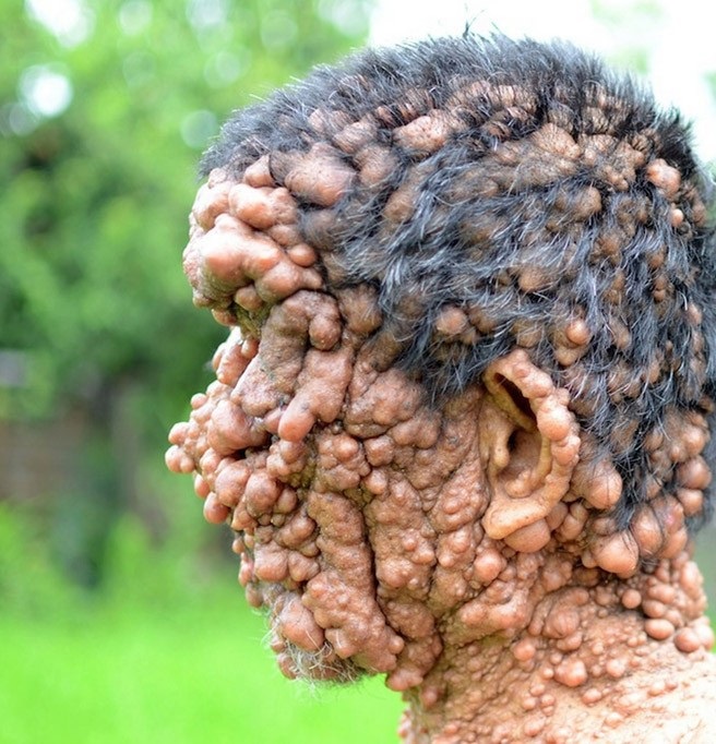 Человек-пузырь и его ужасное заболевание Человек-пузырь Сламет, ужасное заболевание, нейрофиброматоз