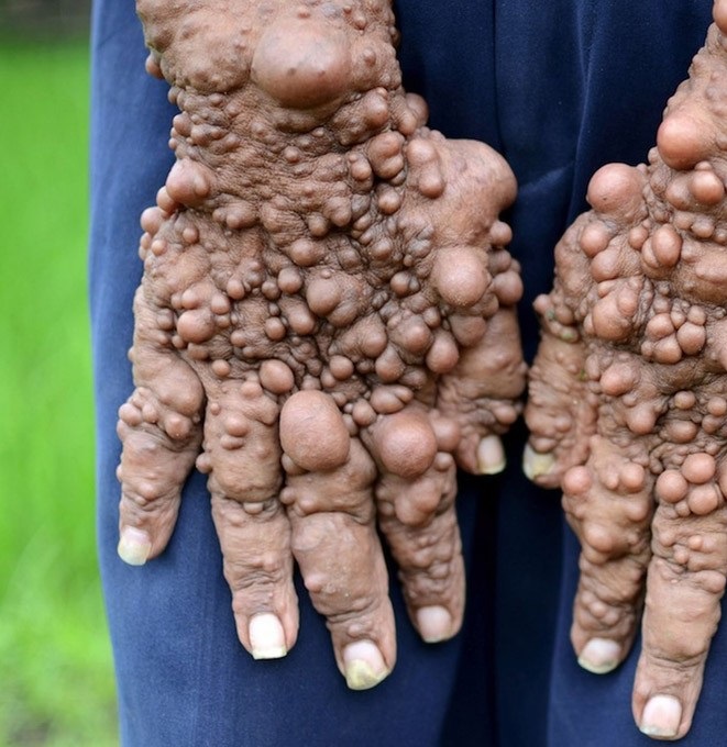 Человек-пузырь и его ужасное заболевание Человек-пузырь Сламет, ужасное заболевание, нейрофиброматоз