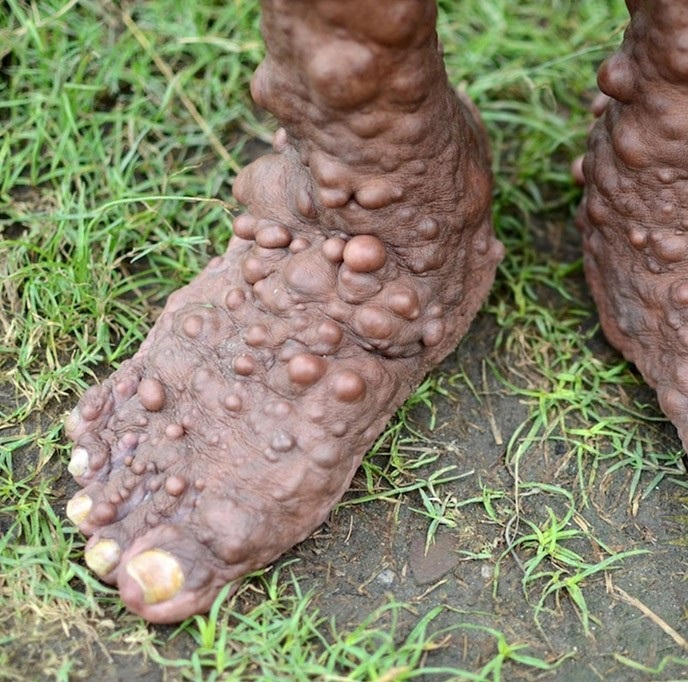 Человек-пузырь и его ужасное заболевание Человек-пузырь Сламет, ужасное заболевание, нейрофиброматоз