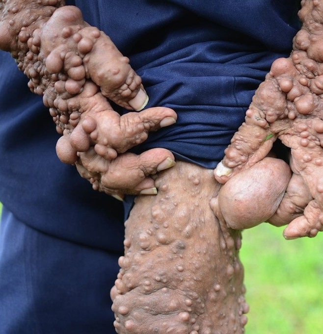 Человек-пузырь и его ужасное заболевание Человек-пузырь Сламет, ужасное заболевание, нейрофиброматоз