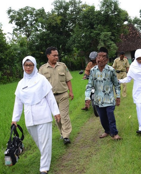 Человек-пузырь и его ужасное заболевание Человек-пузырь Сламет, ужасное заболевание, нейрофиброматоз