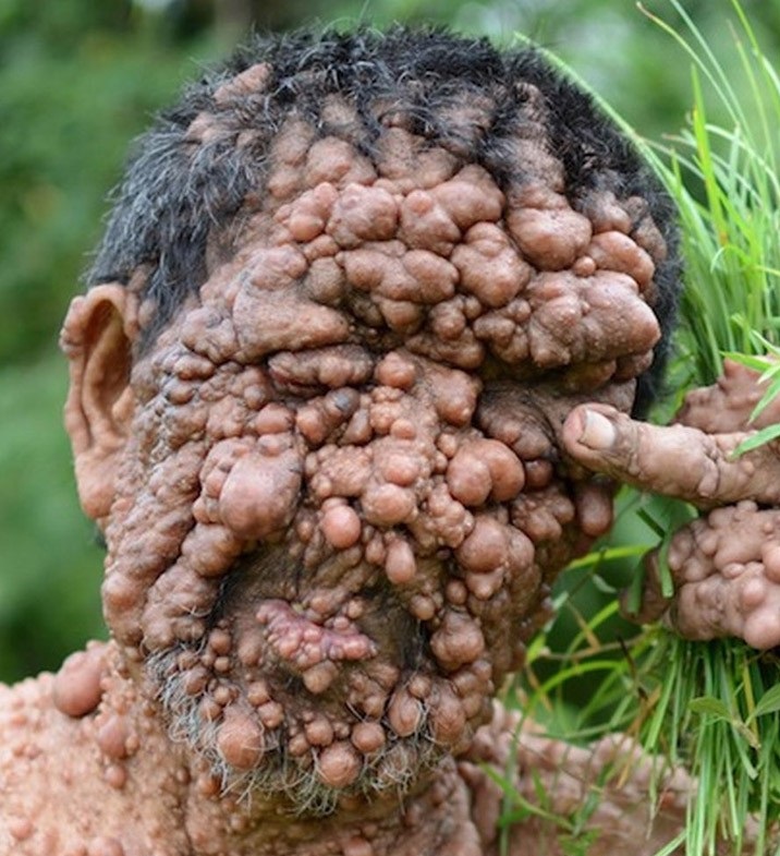 Человек-пузырь и его ужасное заболевание Человек-пузырь Сламет, ужасное заболевание, нейрофиброматоз