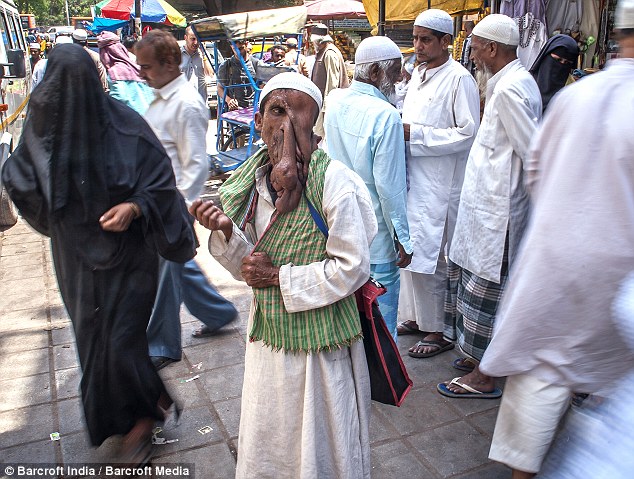 Человек-слон из Индии, человек слон отказался от операции, Маннан Мондал, Mannan Mondal