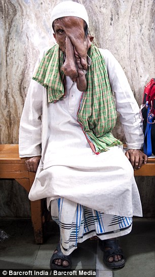 Человек-слон из Индии, человек слон отказался от операции, Маннан Мондал, Mannan Mondal