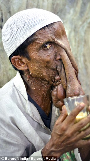 Человек-слон из Индии, человек слон отказался от операции, Маннан Мондал, Mannan Mondal