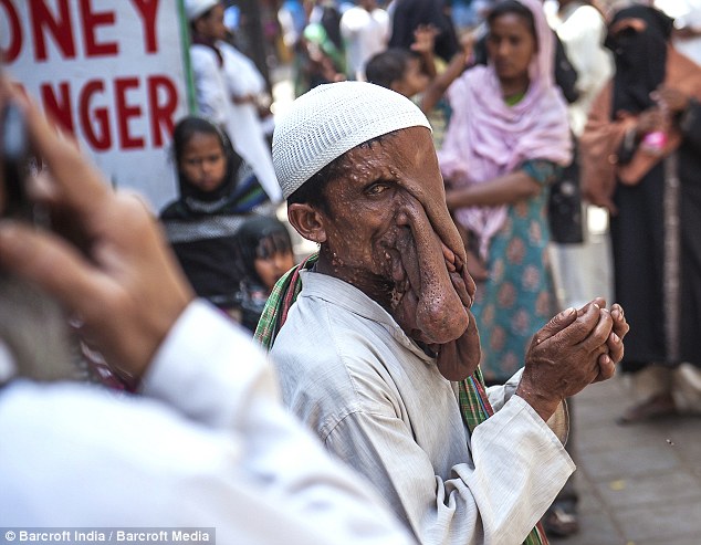 Человек-слон из Индии, человек слон отказался от операции, Маннан Мондал, Mannan Mondal