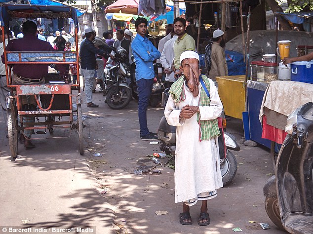 Человек-слон из Индии, человек слон отказался от операции, Маннан Мондал, Mannan Mondal