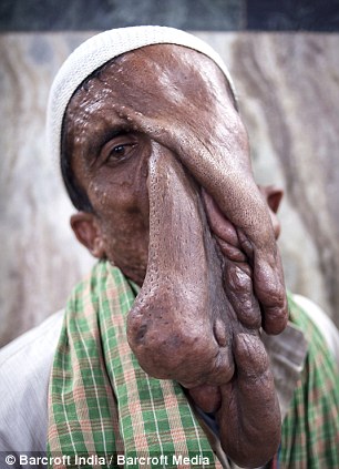 Человек-слон из Индии, человек слон отказался от операции, Маннан Мондал, Mannan Mondal