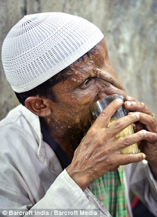 Человек-слон из Индии, человек слон отказался от операции, Маннан Мондал, Mannan Mondal