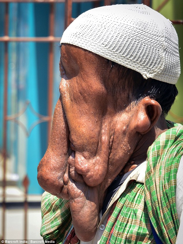 Человек-слон из Индии, человек слон отказался от операции, Маннан Мондал, Mannan Mondal