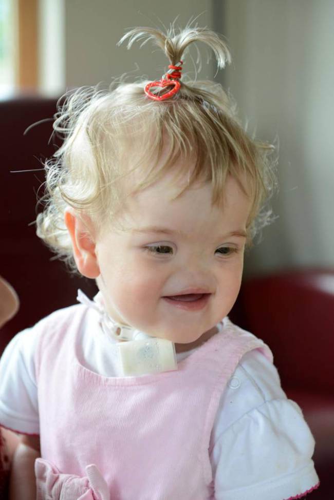 Tessa Evans Тесса Эванс, девочка без носа, аплазия