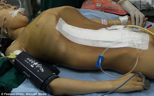 гигантская опухоль у китайской девочки, тератома яичников, Хан Бингбинг, Han Bingbing