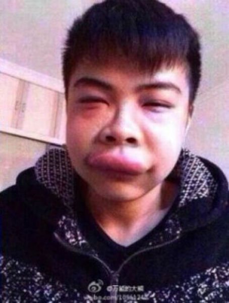 За губу укусила черепаха, отек лица от укуса, укусил трионикс