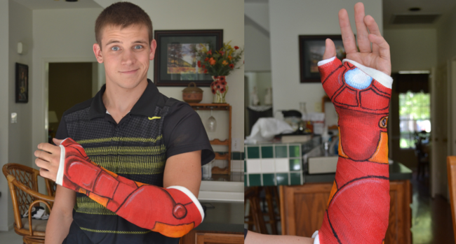 креативный гипс, необычные творческие повязки, разрисованный гипс, рисунки на гипсе