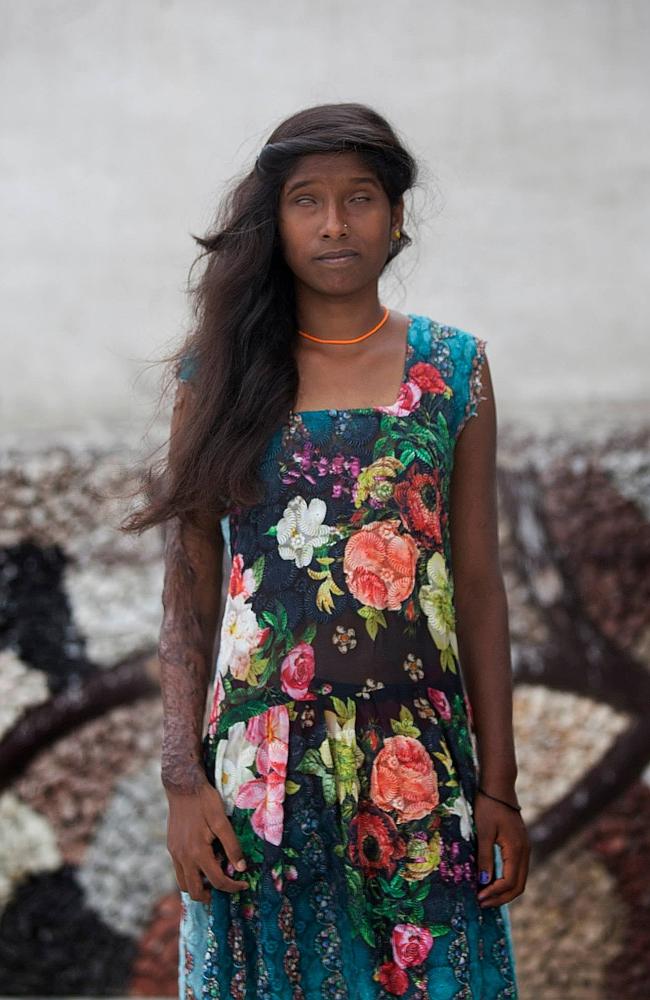 Rahul Saharan Рахул Сахара, облитые кислотой индия