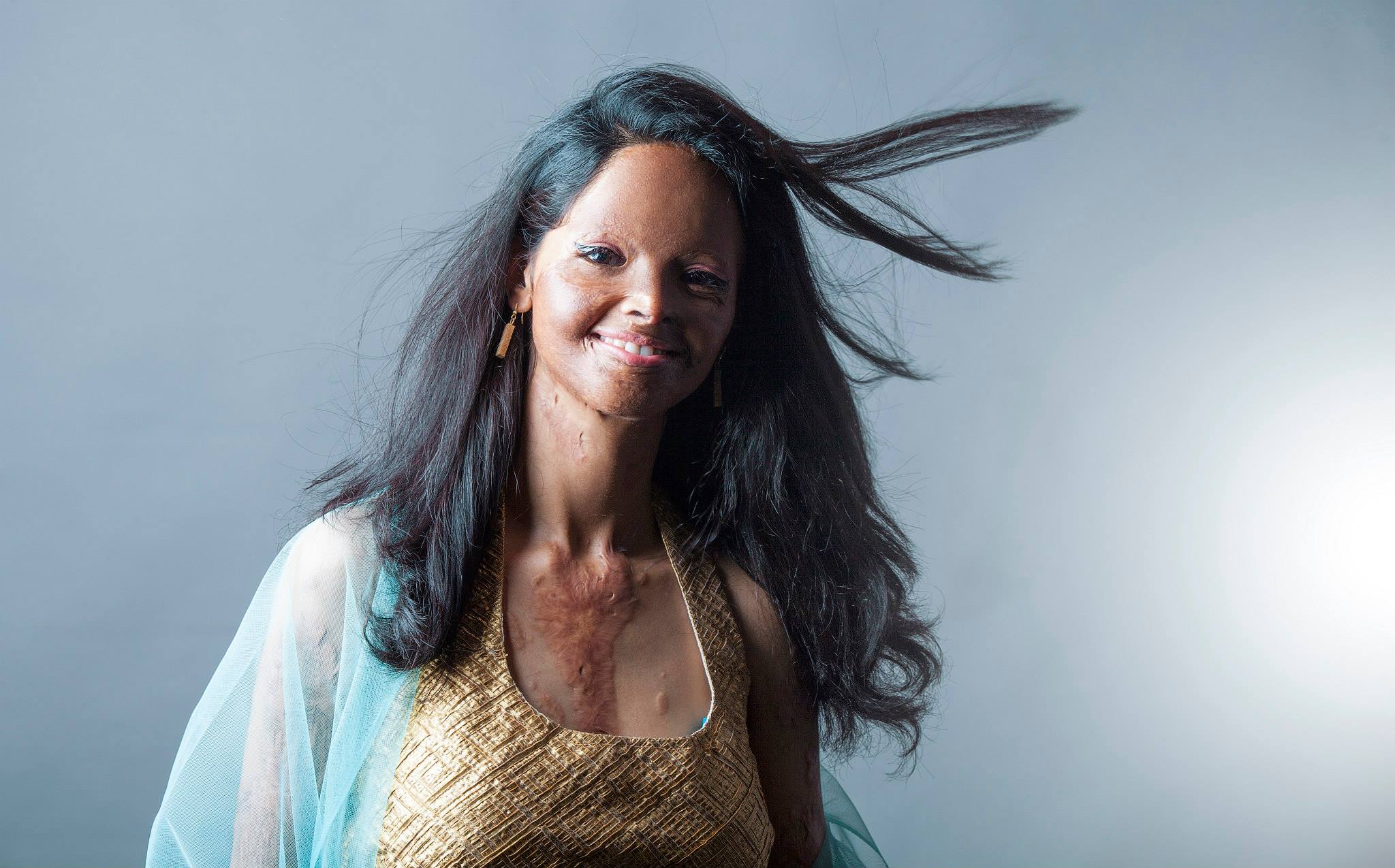 Rahul Saharan Рахул Сахара, облитые кислотой индия