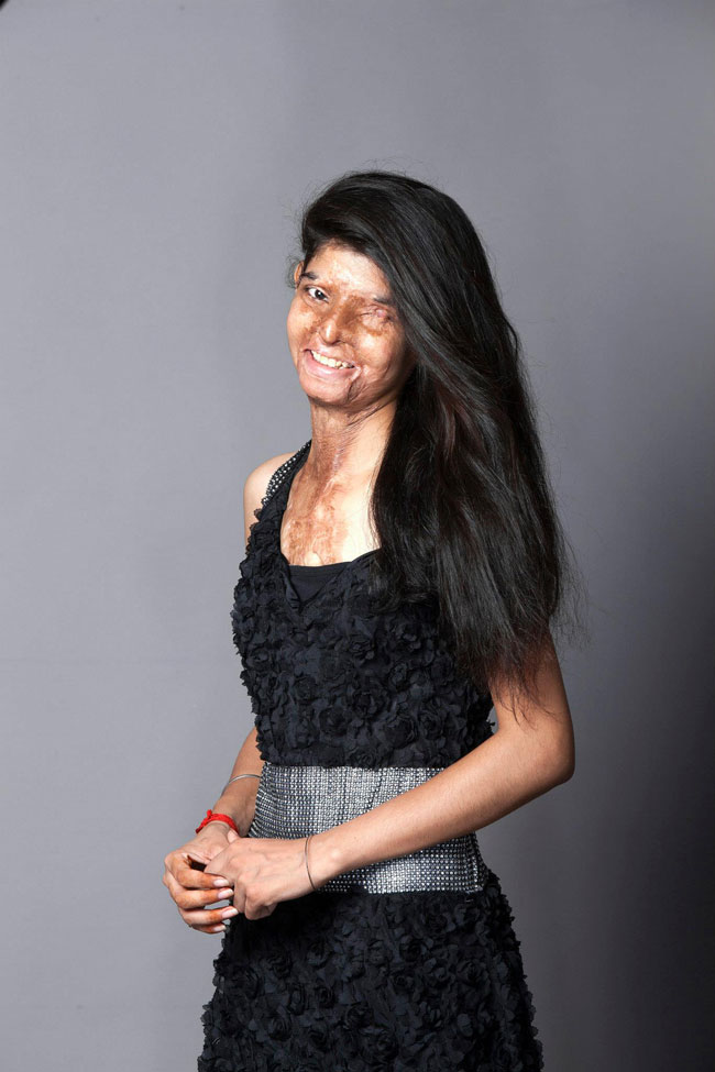 Rahul Saharan Рахул Сахара, облитые кислотой индия