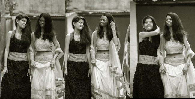 Rahul Saharan Рахул Сахара, облитые кислотой индия