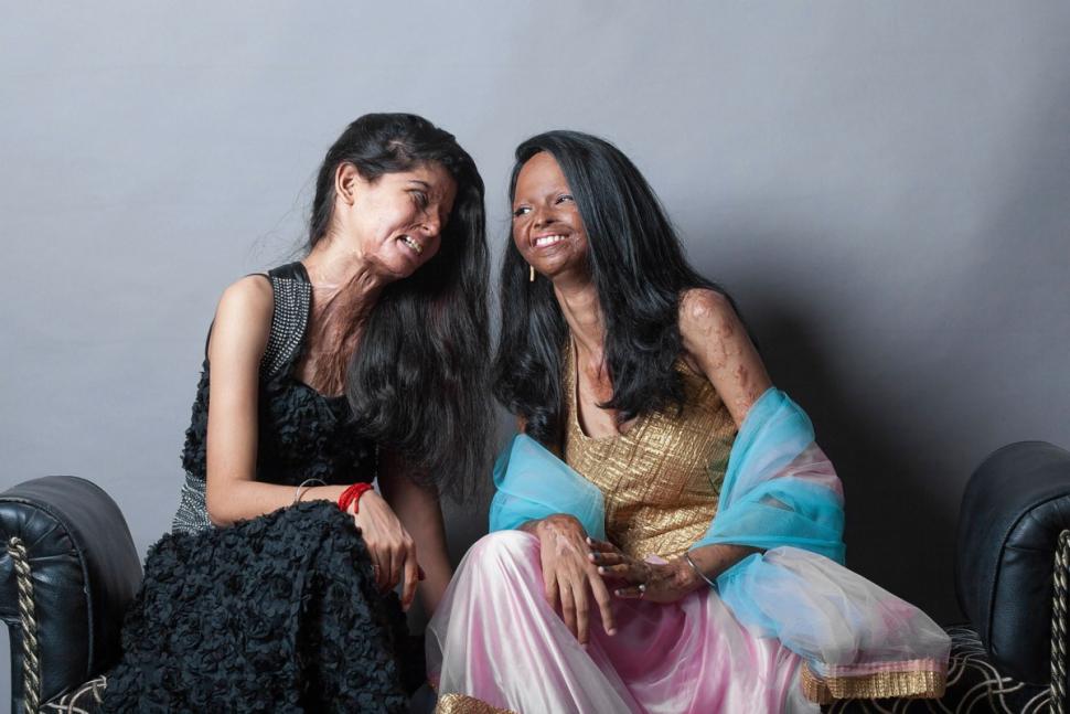 Rahul Saharan Рахул Сахара, облитые кислотой индия