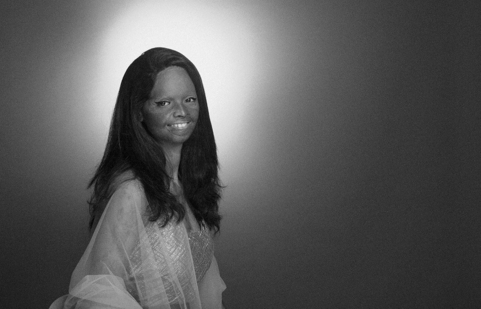 Rahul Saharan Рахул Сахара, облитые кислотой индия