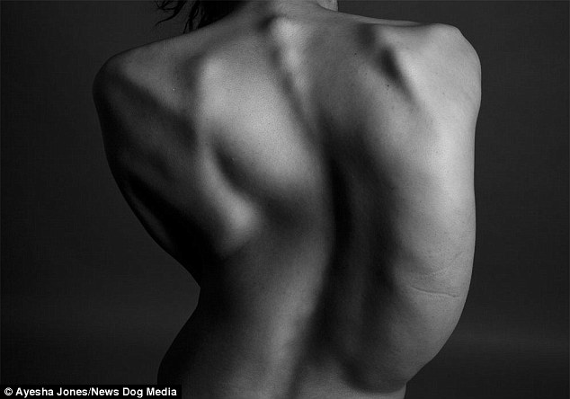 Айша Джонс, Ayesha Jones, девушка с кривой спиной стала моделью, страшный сколиоз