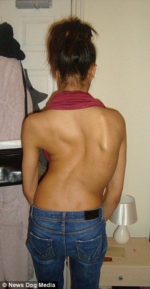 Айша Джонс, Ayesha Jones, девушка с кривой спиной стала моделью, страшный сколиоз