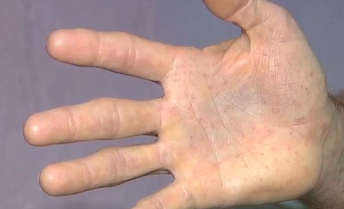 Перепутал опоссума и дикобраза, Антонио Родригес Мороро Antonio Rodrigues Mororó, схватил дикобраза