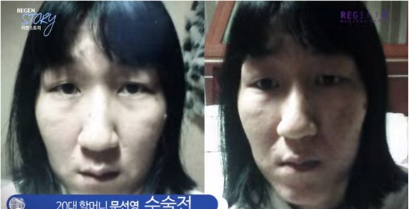 Пластическая хиргия Южная Корея,превращение в красавицу операции, Мун Сан Янг, Moon Sun Young