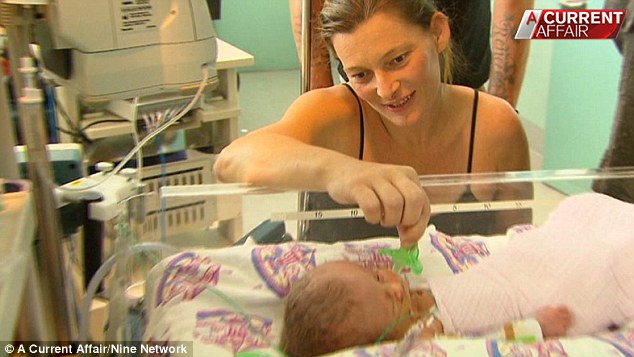 В Австралии родились сиамские близнецы, у которых одно тело на двоих, но два мозга Дипрозоп сиамские близнецы, симаские близнецы два лица и два мозга, Рене Янг, Саймон Хоуи