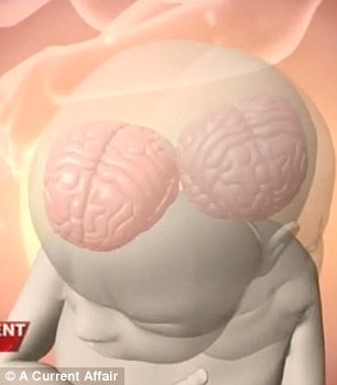 Дипрозоп  сиамские близнецы, симаские близнецы два лица и два мозга, Рене Янг, Саймон Хоуи