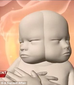 В Австралии родились сиамские близнецы, у которых одно тело на двоих, но два мозга Дипрозоп сиамские близнецы, симаские близнецы два лица и два мозга, Рене Янг, Саймон Хоуи