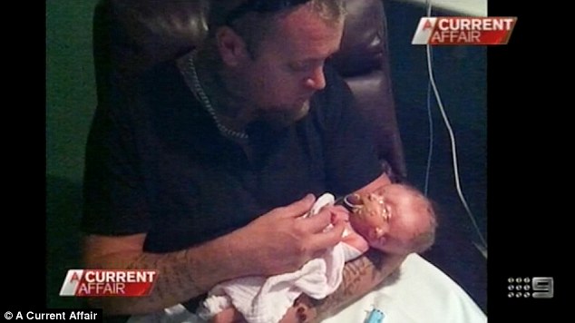 В Австралии родились сиамские близнецы, у которых одно тело на двоих, но два мозга Дипрозоп сиамские близнецы, симаские близнецы два лица и два мозга, Рене Янг, Саймон Хоуи