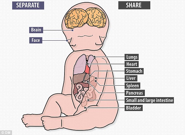 В Австралии родились сиамские близнецы, у которых одно тело на двоих, но два мозга Дипрозоп сиамские близнецы, симаские близнецы два лица и два мозга, Рене Янг, Саймон Хоуи